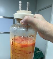 兴化水动力吸脂手术要做多久？
